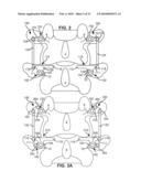 MODULAR IN-LINE DEFLECTION ROD AND BONE ANCHOR SYSTEM AND METHOD FOR DYNAMIC STABILIZATION OF THE SPINE diagram and image