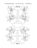 MODULAR IN-LINE DEFLECTION ROD AND BONE ANCHOR SYSTEM AND METHOD FOR DYNAMIC STABILIZATION OF THE SPINE diagram and image