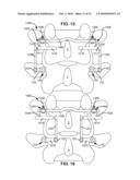 MODULAR IN-LINE DEFLECTION ROD AND BONE ANCHOR SYSTEM AND METHOD FOR DYNAMIC STABILIZATION OF THE SPINE diagram and image