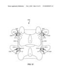 MODULAR IN-LINE DEFLECTION ROD AND BONE ANCHOR SYSTEM AND METHOD FOR DYNAMIC STABILIZATION OF THE SPINE diagram and image