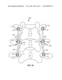 MODULAR IN-LINE DEFLECTION ROD AND BONE ANCHOR SYSTEM AND METHOD FOR DYNAMIC STABILIZATION OF THE SPINE diagram and image