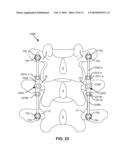 MODULAR IN-LINE DEFLECTION ROD AND BONE ANCHOR SYSTEM AND METHOD FOR DYNAMIC STABILIZATION OF THE SPINE diagram and image