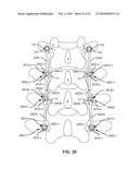 MODULAR IN-LINE DEFLECTION ROD AND BONE ANCHOR SYSTEM AND METHOD FOR DYNAMIC STABILIZATION OF THE SPINE diagram and image