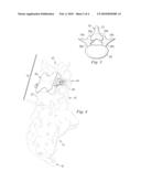 INTERVERTEBRAL PROSTHETIC DEVICE FOR SPINAL STABILIZATION AND METHOD OF IMPLANTING SAME diagram and image