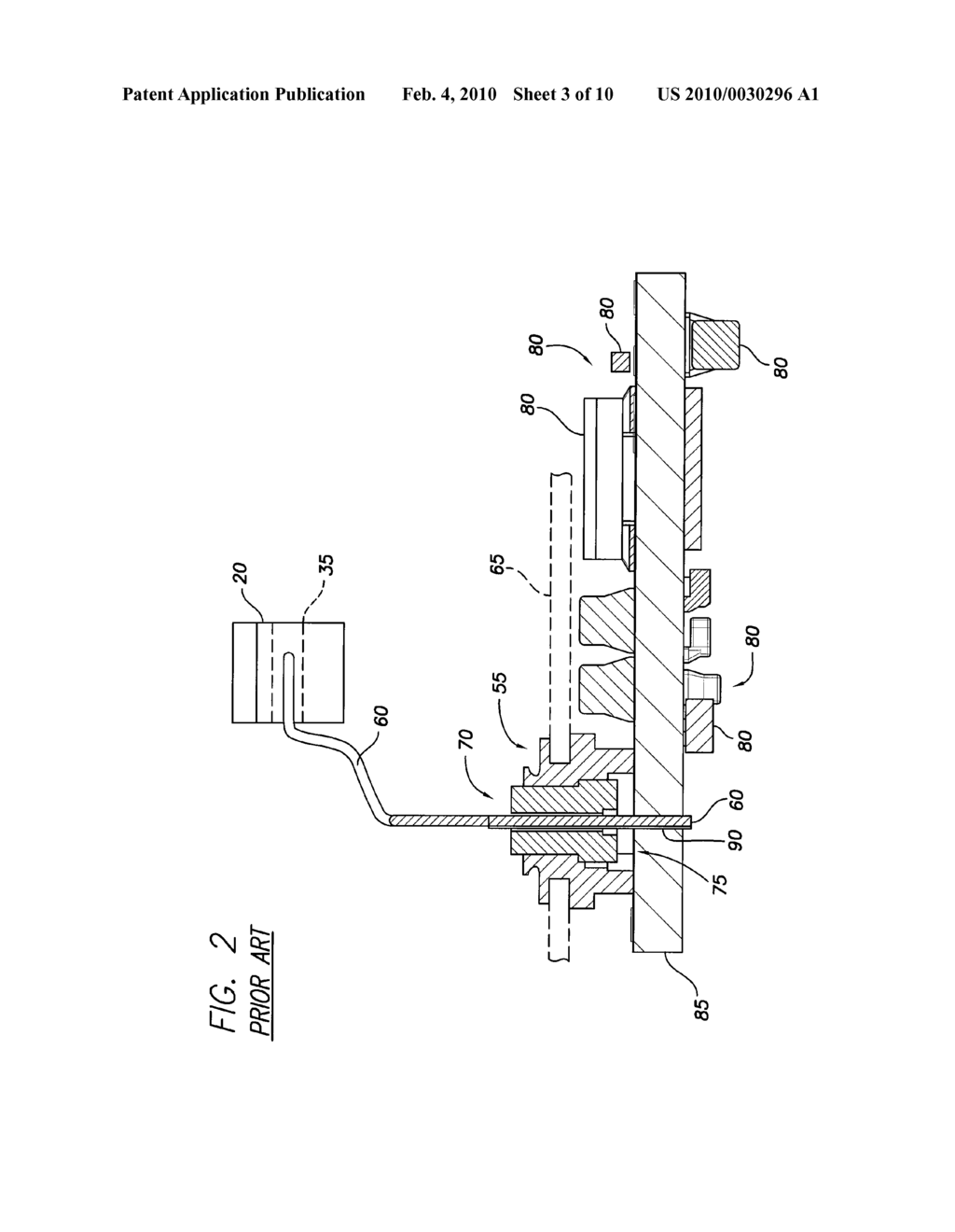 IMPLANTABLE PULSE GENERATOR FEEDTHRUS AND METHODS OF MANUFACTURE - diagram, schematic, and image 04