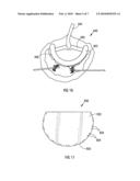 Annuloplasty Prosthesis diagram and image