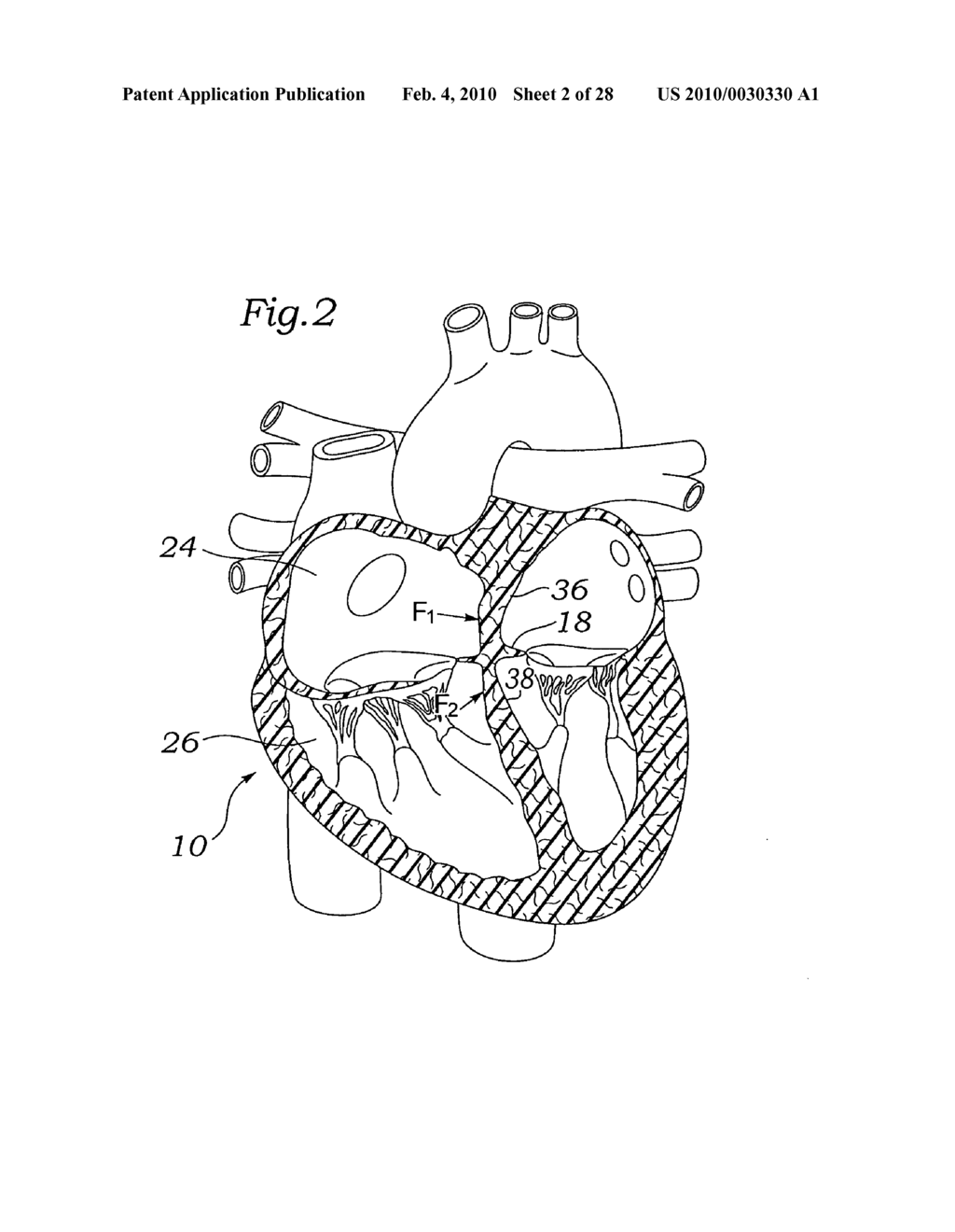 Device and method for mitral valve repair - diagram, schematic, and image 03