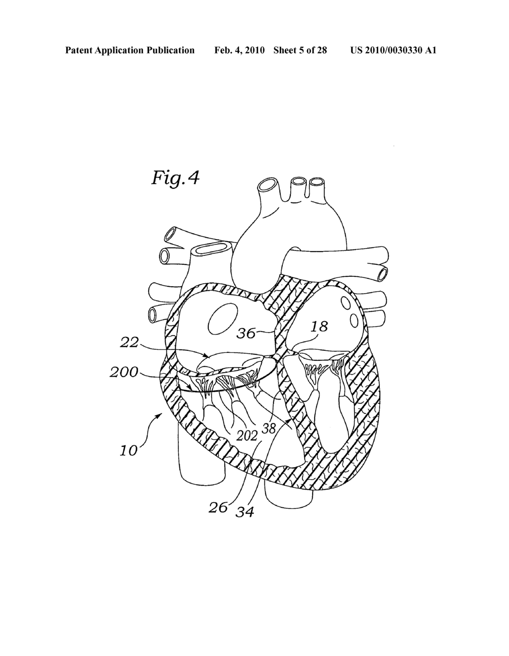 Device and method for mitral valve repair - diagram, schematic, and image 06