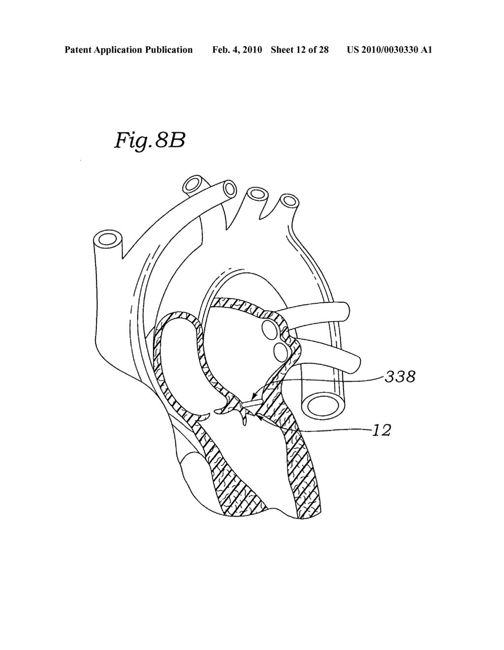 Device and method for mitral valve repair - diagram, schematic, and image 13