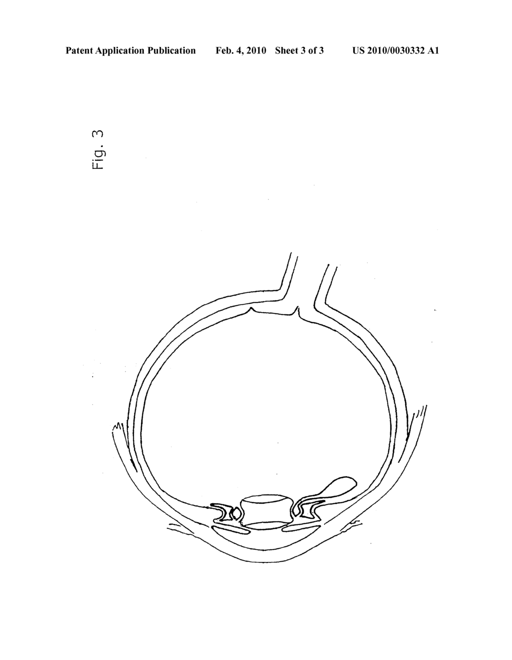 ACCOMMODATIVE LENS IMPLANT, CONTROLLED BY THE CILIARY MUSCLE - diagram, schematic, and image 04