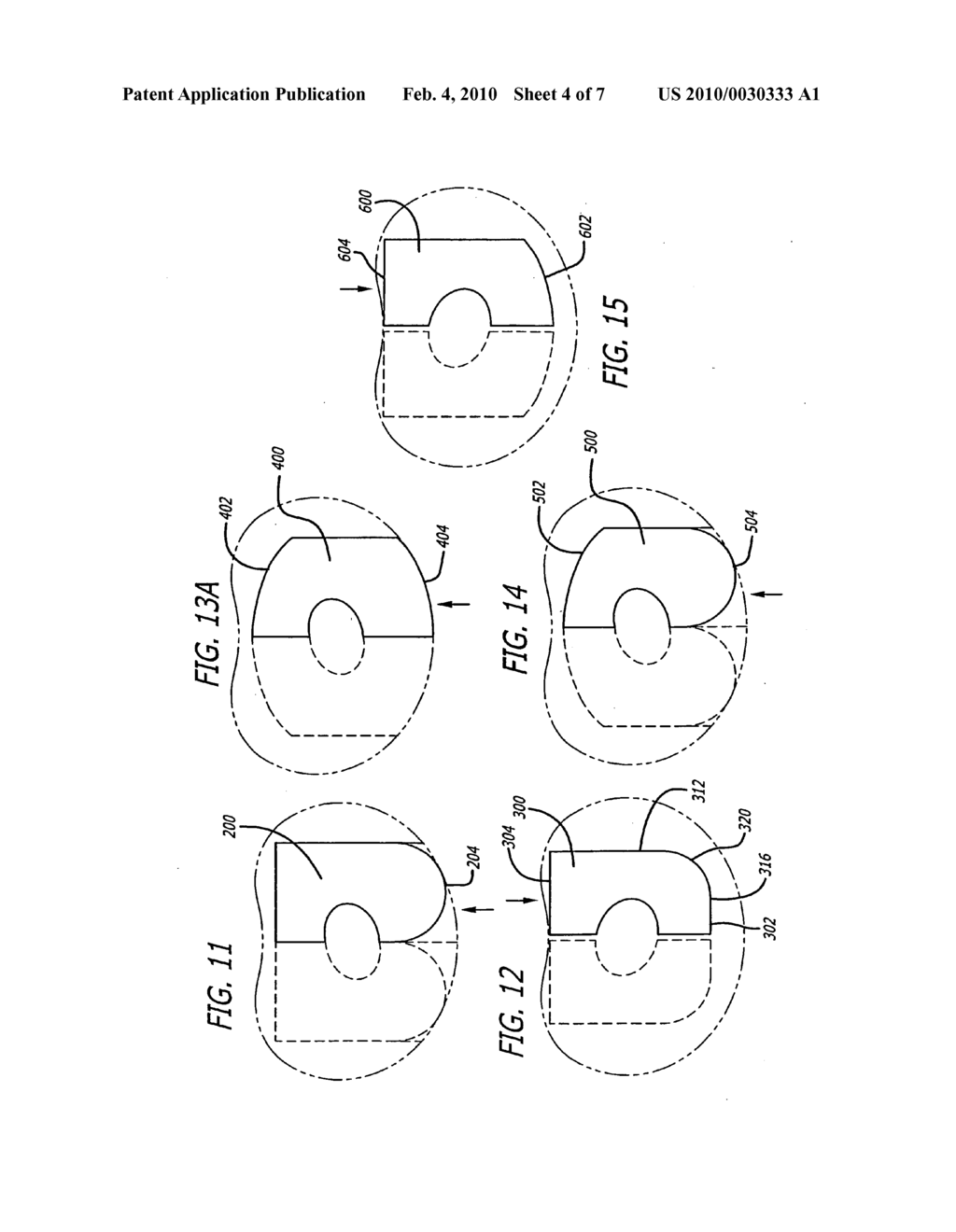 Hemi-interbody spinal fusion implants manufactured from a major long bone ring - diagram, schematic, and image 05