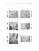 ENDOTHELIAL PROGENITOR CELL COMPOSITIONS AND NEOVASCULARIZATION diagram and image