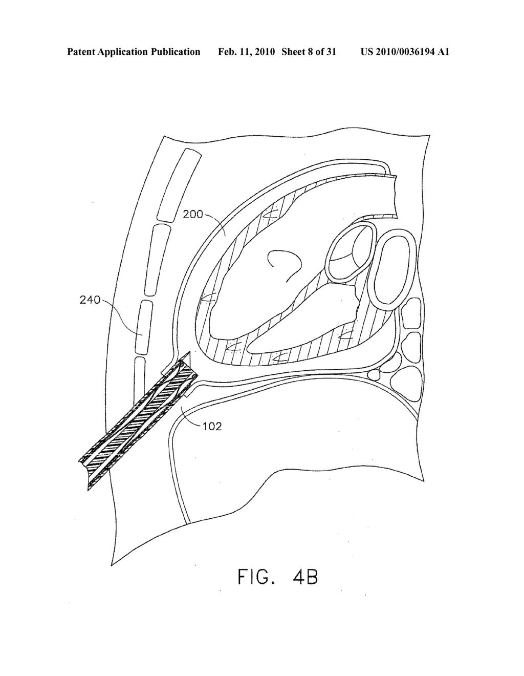 METHOD AND DEVICE FOR DEPLOYMENT OF A SUB-PERICARDIAL SACK - diagram, schematic, and image 09