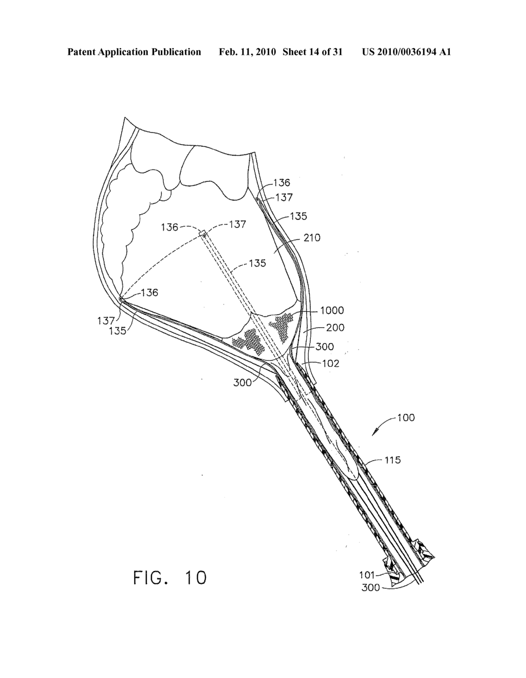 METHOD AND DEVICE FOR DEPLOYMENT OF A SUB-PERICARDIAL SACK - diagram, schematic, and image 15