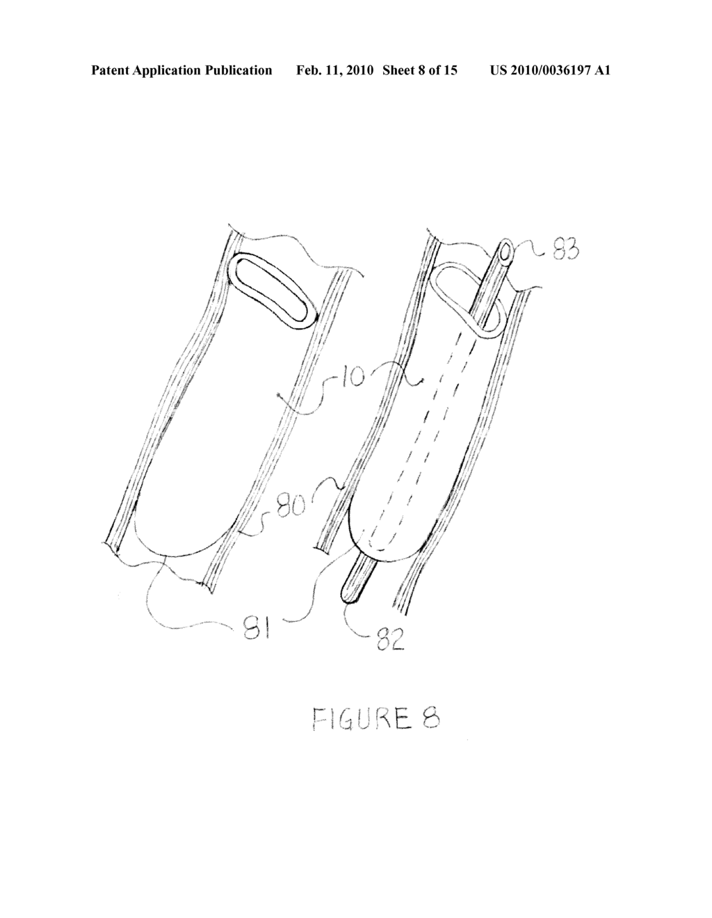 Methods and apparatus for transesophageal microaccess surgery - diagram, schematic, and image 09