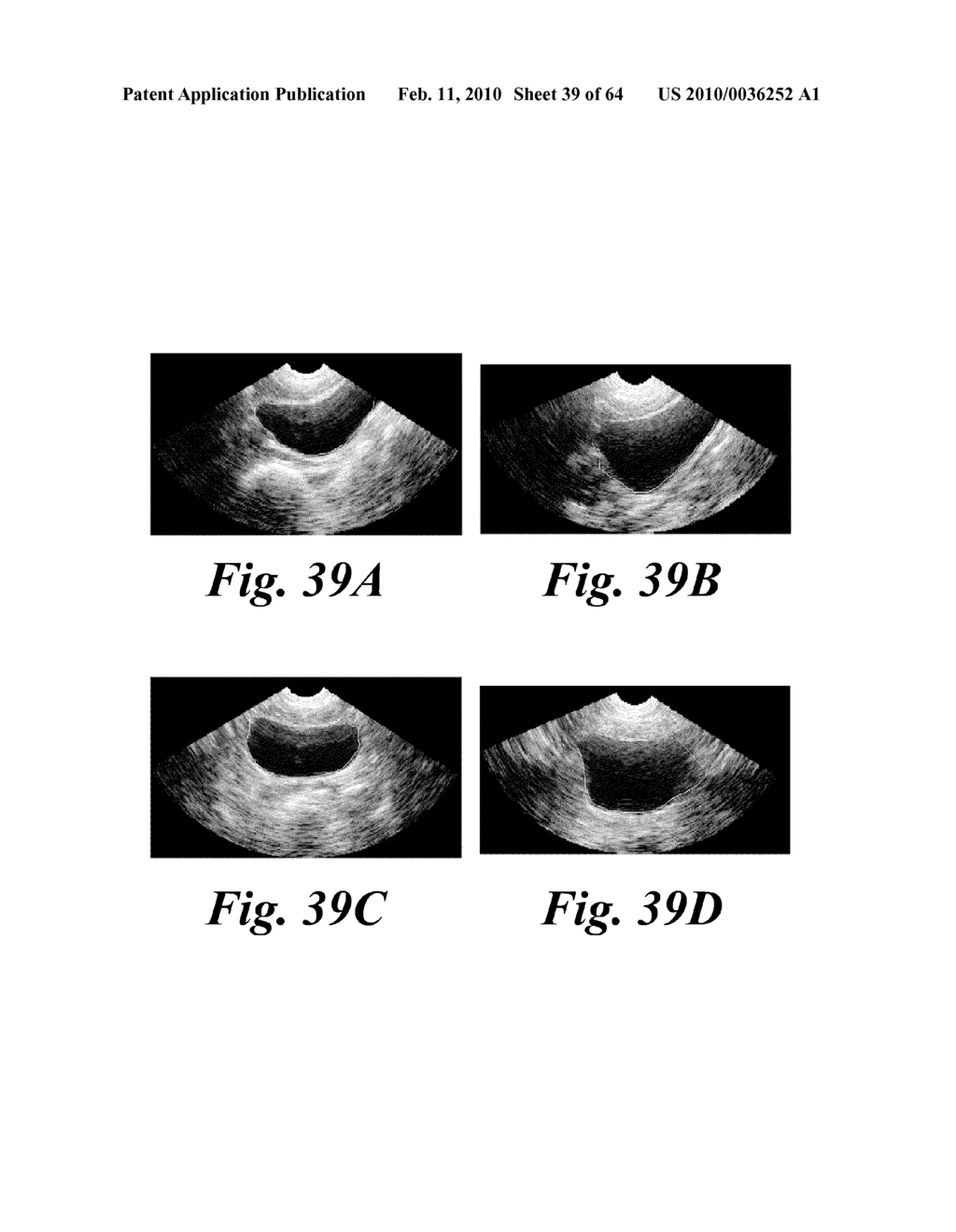 ULTRASOUND SYSTEM AND METHOD FOR MEASURING BLADDER WALL THICKNESS AND MASS - diagram, schematic, and image 40