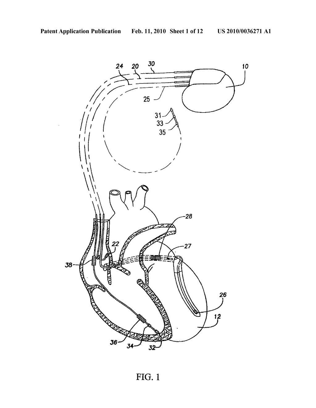 FREQUENCY DOMAIN MONITORING OF MYOCARDIAL ELECTRICAL STABILITY - diagram, schematic, and image 02