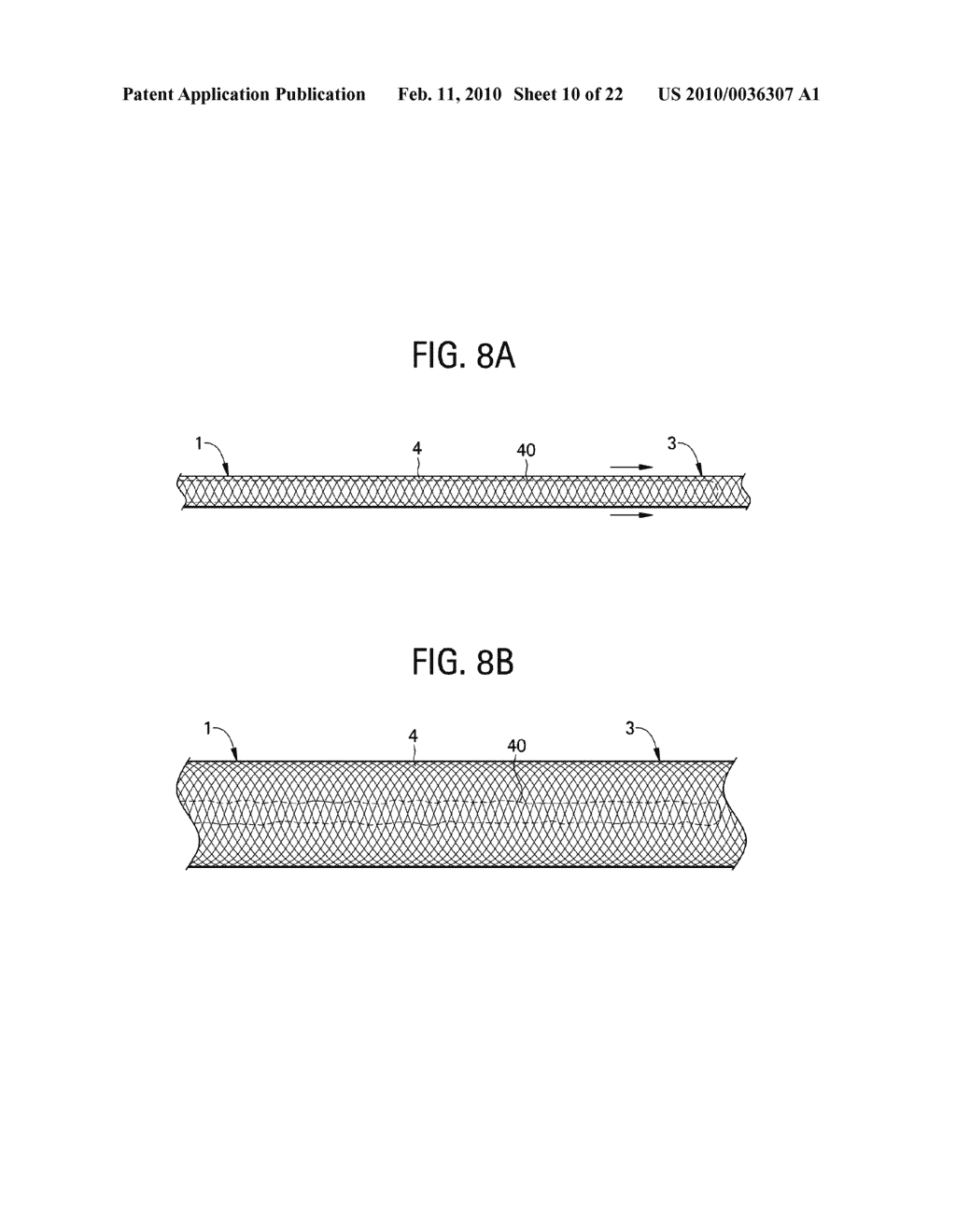 METHODS, APPARATUSES AND SYSTEMS FOR CAVAL STENTING FOR VENOUS DRAINAGE - diagram, schematic, and image 11