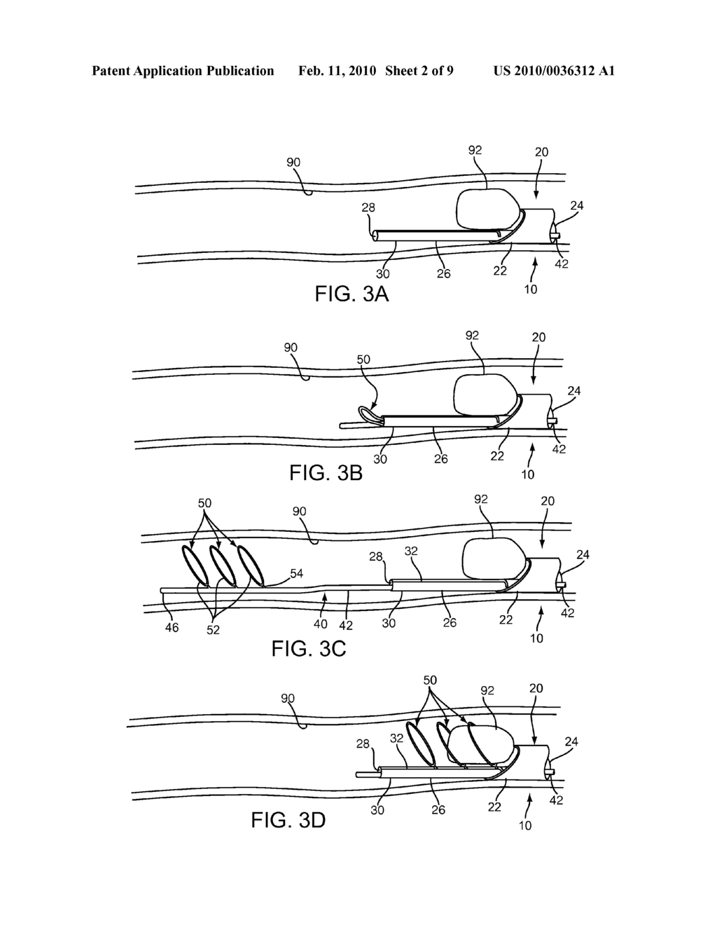 APPARATUS AND METHODS FOR REMOVING OBSTRUCTIVE MATERIAL FROM BODY LUMENS - diagram, schematic, and image 03