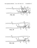 APPARATUS AND METHODS FOR REMOVING OBSTRUCTIVE MATERIAL FROM BODY LUMENS diagram and image