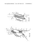 STENT GRAFT DELIVERY SYSTEM diagram and image