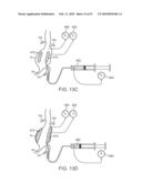 STENT GRAFT DELIVERY SYSTEM diagram and image