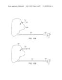 STENT GRAFT DELIVERY SYSTEM diagram and image