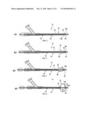 APPARATUS AND METHODS FOR TREATING OBSTRUCTIONS WITHIN BODY LUMENS diagram and image