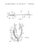 APPARATUS AND METHODS FOR TREATING OBSTRUCTIONS WITHIN BODY LUMENS diagram and image