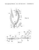 APPARATUS AND METHODS FOR TREATING OBSTRUCTIONS WITHIN BODY LUMENS diagram and image