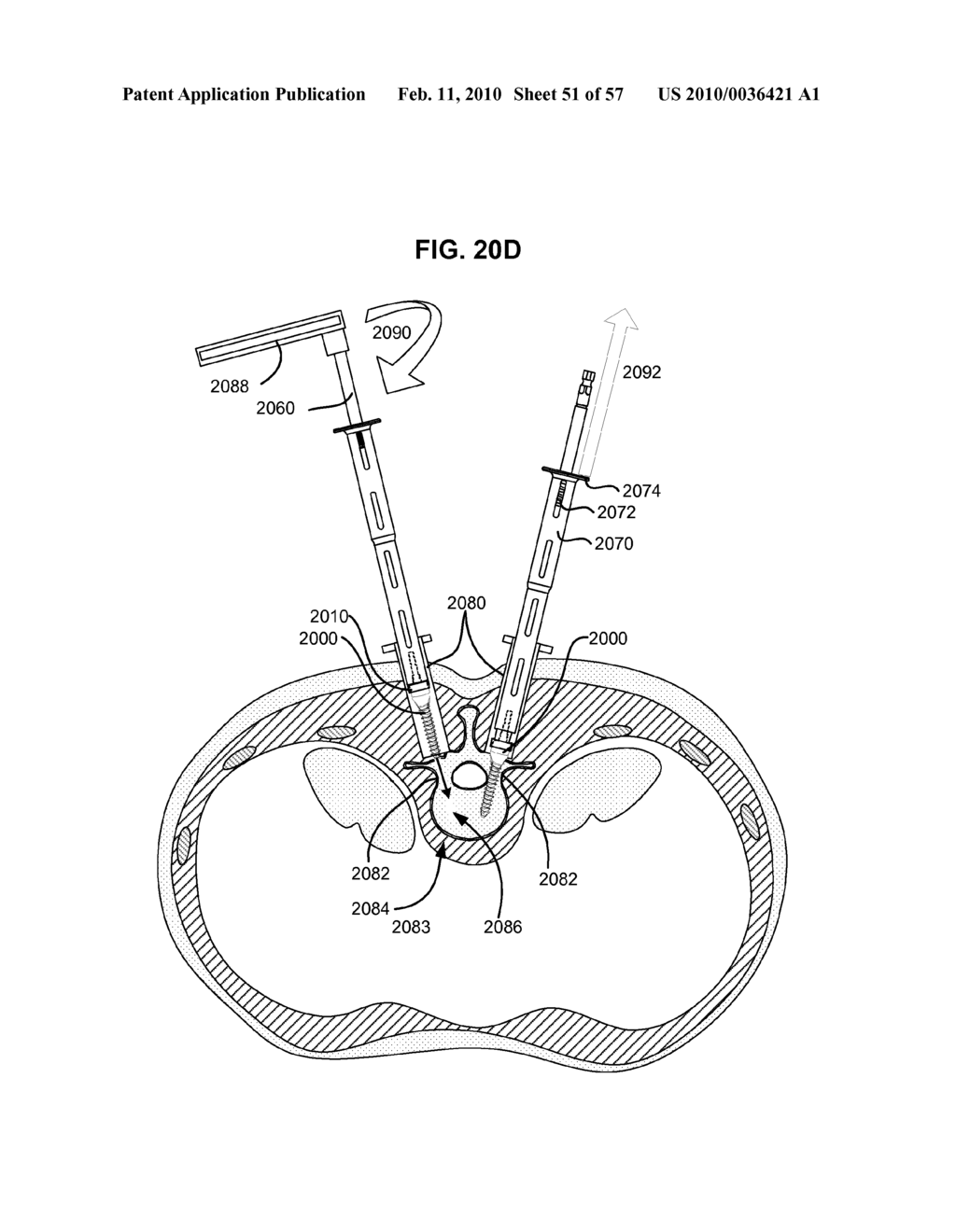 LOAD-SHARING COMPONENT HAVING A DEFLECTABLE POST AND METHOD FOR DYNAMIC STABILIZATION OF THE SPINE - diagram, schematic, and image 52