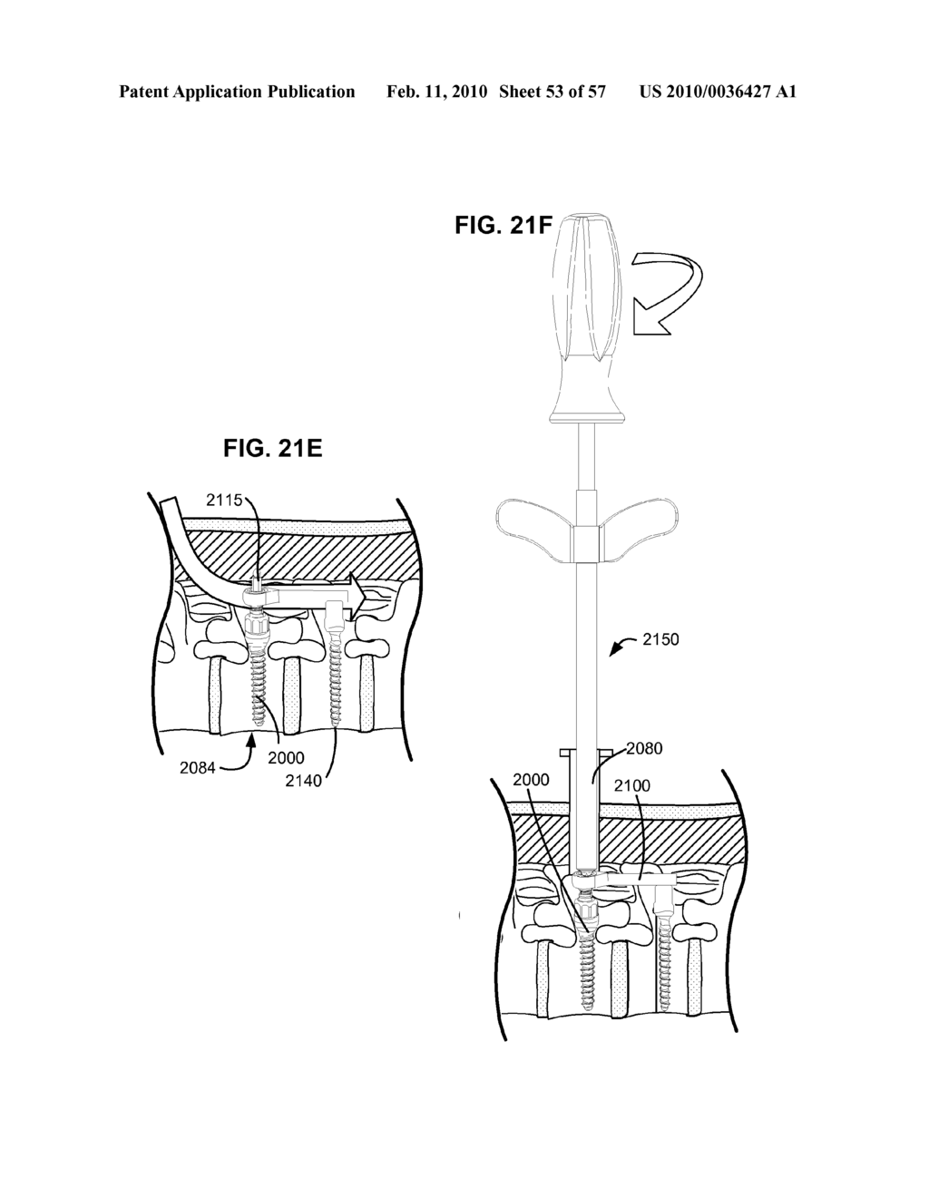 LOAD-SHARING BONE ANCHOR HAVING A DEFLECTABLE POST AND METHOD FOR STABILIZATION OF THE SPINE - diagram, schematic, and image 54