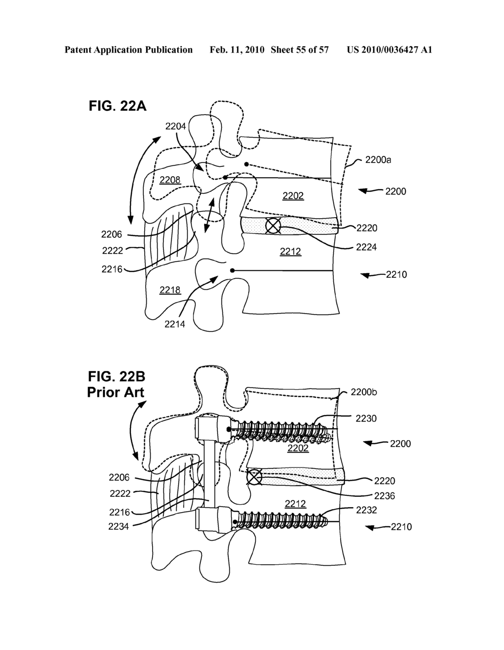 LOAD-SHARING BONE ANCHOR HAVING A DEFLECTABLE POST AND METHOD FOR STABILIZATION OF THE SPINE - diagram, schematic, and image 56