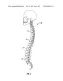 RESCUE REDUCTION BONE ANCHOR diagram and image