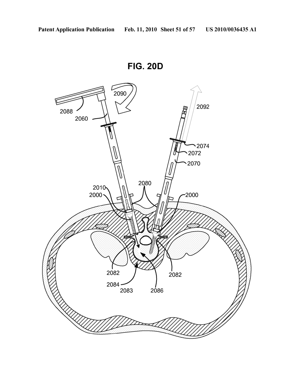 LOAD-SHARING BONE ANCHOR HAVING A DEFLECTABLE POST AND METHOD FOR DYNAMIC STABILIZATION OF THE SPINE - diagram, schematic, and image 52