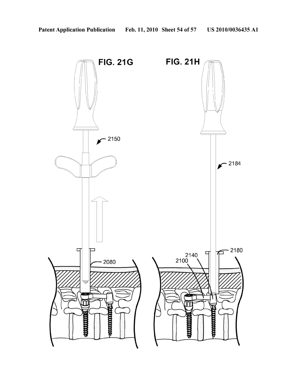 LOAD-SHARING BONE ANCHOR HAVING A DEFLECTABLE POST AND METHOD FOR DYNAMIC STABILIZATION OF THE SPINE - diagram, schematic, and image 55