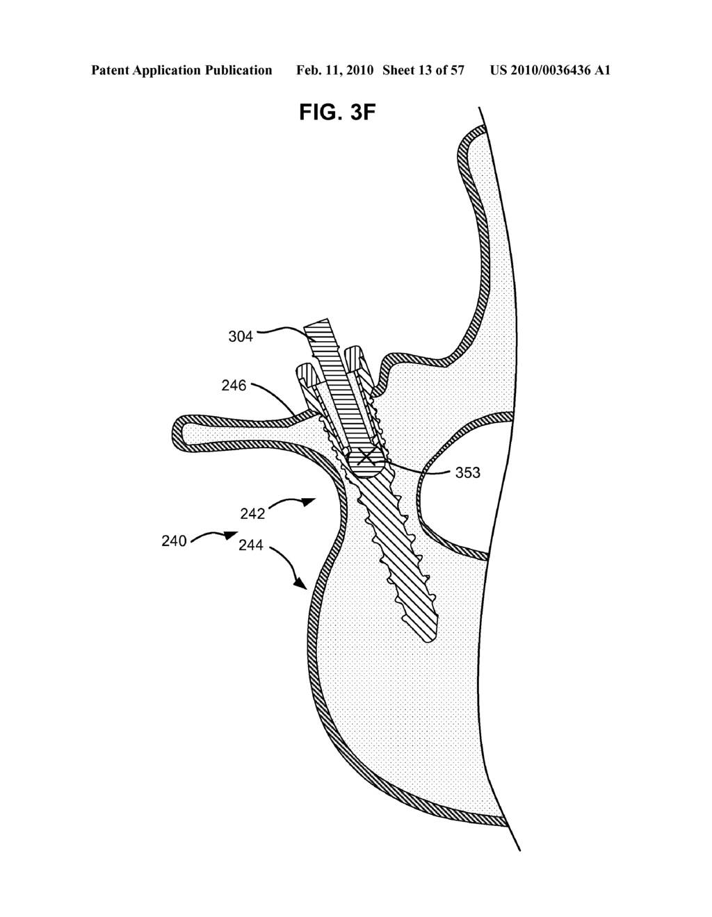 LOAD-SHARING BONE ANCHOR HAVING A DURABLE COMPLIANT MEMBER AND METHOD FOR DYNAMIC STABILIZATION OF THE SPINE - diagram, schematic, and image 14