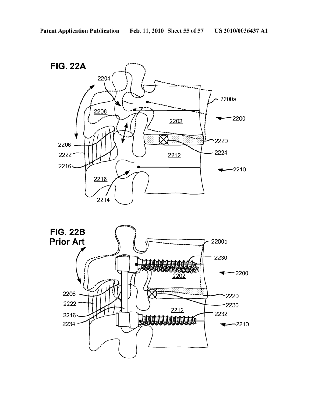 LOAD-SHARING BONE ANCHOR HAVING A DEFLECTABLE POST WITH A COMPLIANT RING AND METHOD FOR STABILIZATION OF THE SPINE - diagram, schematic, and image 56