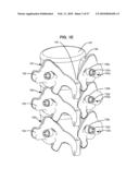 LOAD-SHARING BONE ANCHOR HAVING A DEFLECTABLE POST WITH A COMPLIANT RING AND METHOD FOR STABILIZATION OF THE SPINE diagram and image