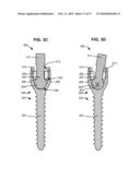 LOAD-SHARING BONE ANCHOR HAVING A DEFLECTABLE POST WITH A COMPLIANT RING AND METHOD FOR STABILIZATION OF THE SPINE diagram and image