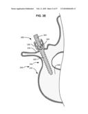 LOAD-SHARING BONE ANCHOR HAVING A DEFLECTABLE POST WITH A COMPLIANT RING AND METHOD FOR STABILIZATION OF THE SPINE diagram and image