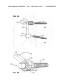 LOAD-SHARING BONE ANCHOR HAVING A DEFLECTABLE POST WITH A COMPLIANT RING AND METHOD FOR STABILIZATION OF THE SPINE diagram and image