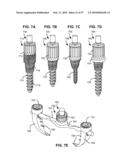 LOAD-SHARING BONE ANCHOR HAVING A DEFLECTABLE POST WITH A COMPLIANT RING AND METHOD FOR STABILIZATION OF THE SPINE diagram and image