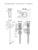 LOAD-SHARING BONE ANCHOR HAVING A DEFLECTABLE POST WITH A COMPLIANT RING AND METHOD FOR STABILIZATION OF THE SPINE diagram and image