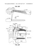 LOAD-SHARING BONE ANCHOR HAVING A DEFLECTABLE POST WITH A COMPLIANT RING AND METHOD FOR STABILIZATION OF THE SPINE diagram and image