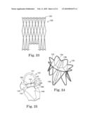 Stented Heart Valve Devices diagram and image