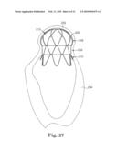 Stented Heart Valve Devices diagram and image