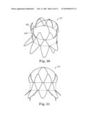 Stented Heart Valve Devices diagram and image