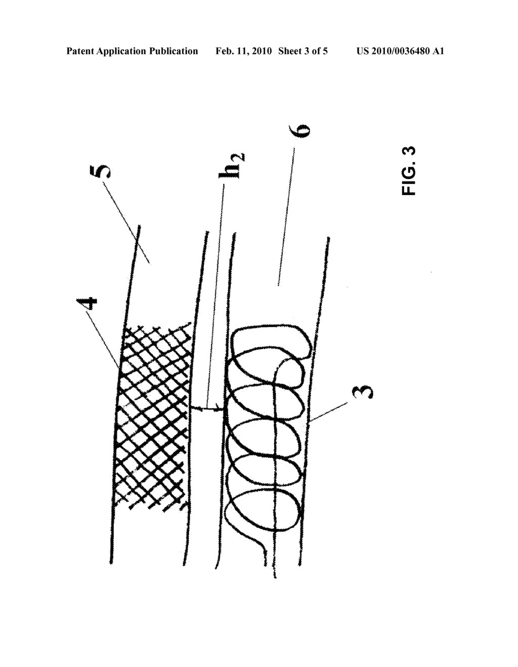 ENDOVASCULAR MAGNETIC METHOD FOR TARGETED DRUG DELIVERY - diagram, schematic, and image 04