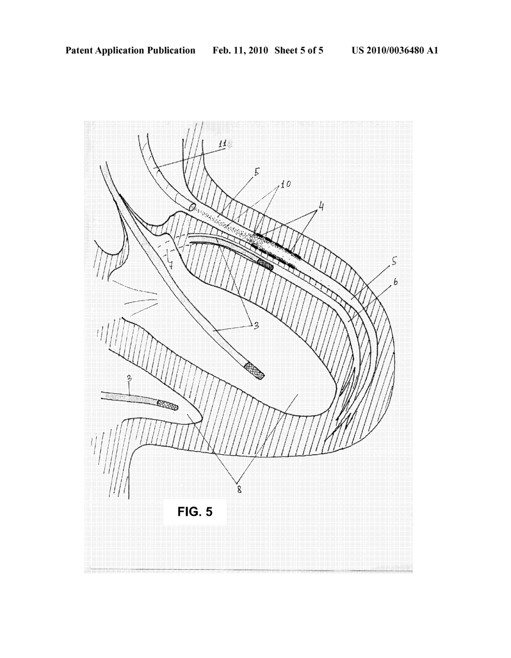 ENDOVASCULAR MAGNETIC METHOD FOR TARGETED DRUG DELIVERY - diagram, schematic, and image 06